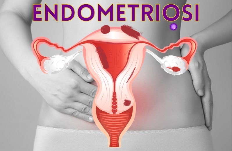 Endometriosi il giornale popolare